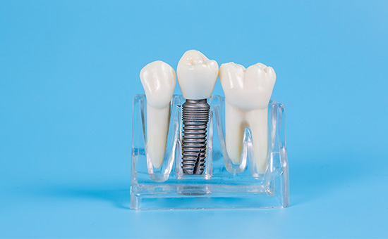 合肥种植牙医院在线资讯-即刻种植牙好还是3月后种植好(图1)