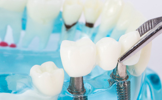 合肥种植牙医院哪个比较好-口碑-种植牙和烤瓷牙哪个好(图1)