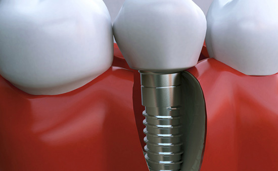 合肥种植牙价格大揭秘！你想知道吗？(图1)