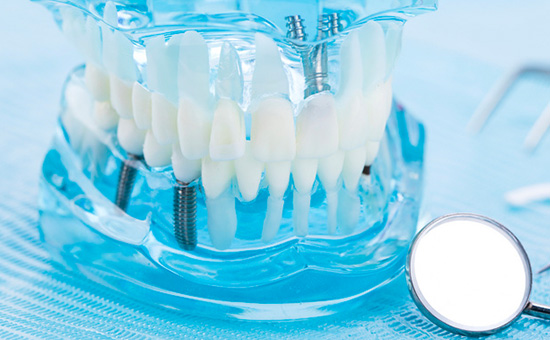 合肥看种植牙-治疗种植牙专业医院“公布”种植牙常见的几个误区(图1)