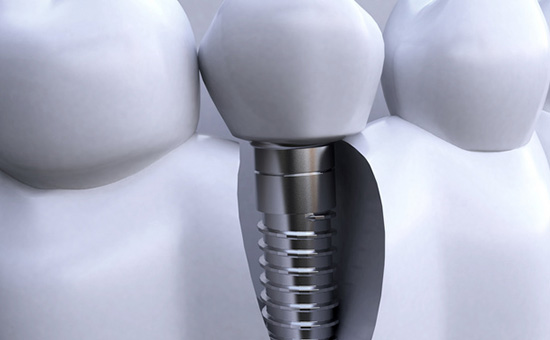 合肥种植牙医院“综合排名推荐”-是做活动义齿好还是种植牙好(图1)